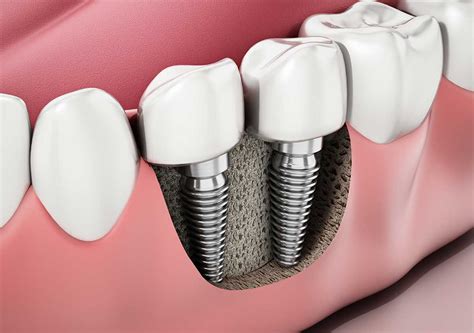 cheapest implant dentist the area orlando